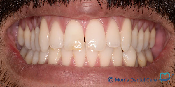 After the treatment which involved clear aligners, composite bonding and teeth whitening our patient was delighted with the confidence having a balanced and whiter smile. 